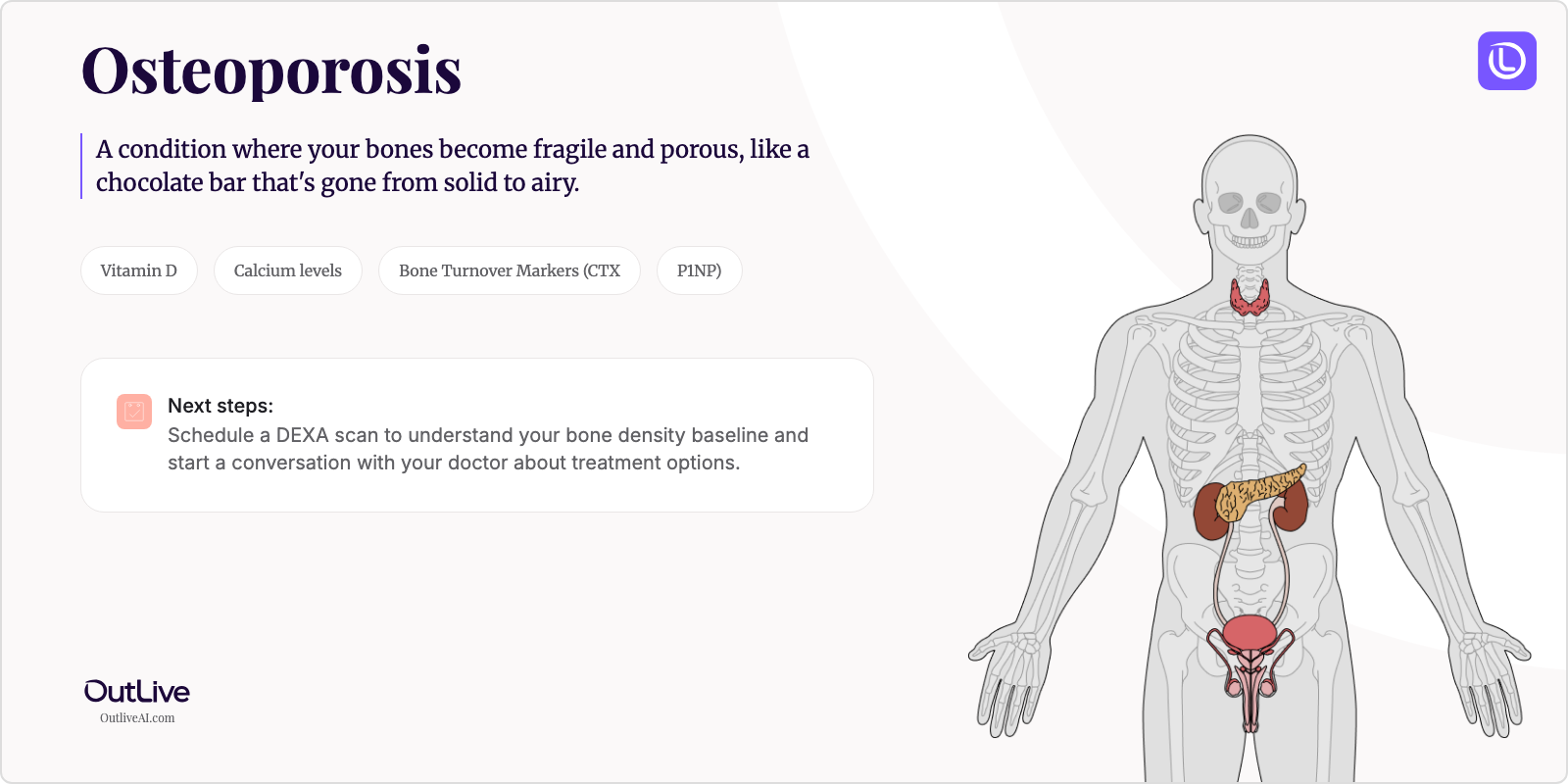 Just Diagnosed with Osteoporosis: A Simple Guide