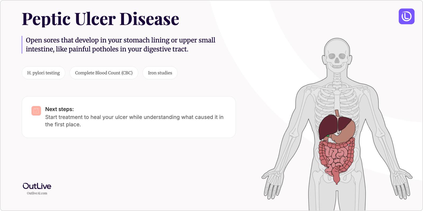 Just Diagnosed with Peptic Ulcer Disease: A Simple Guide